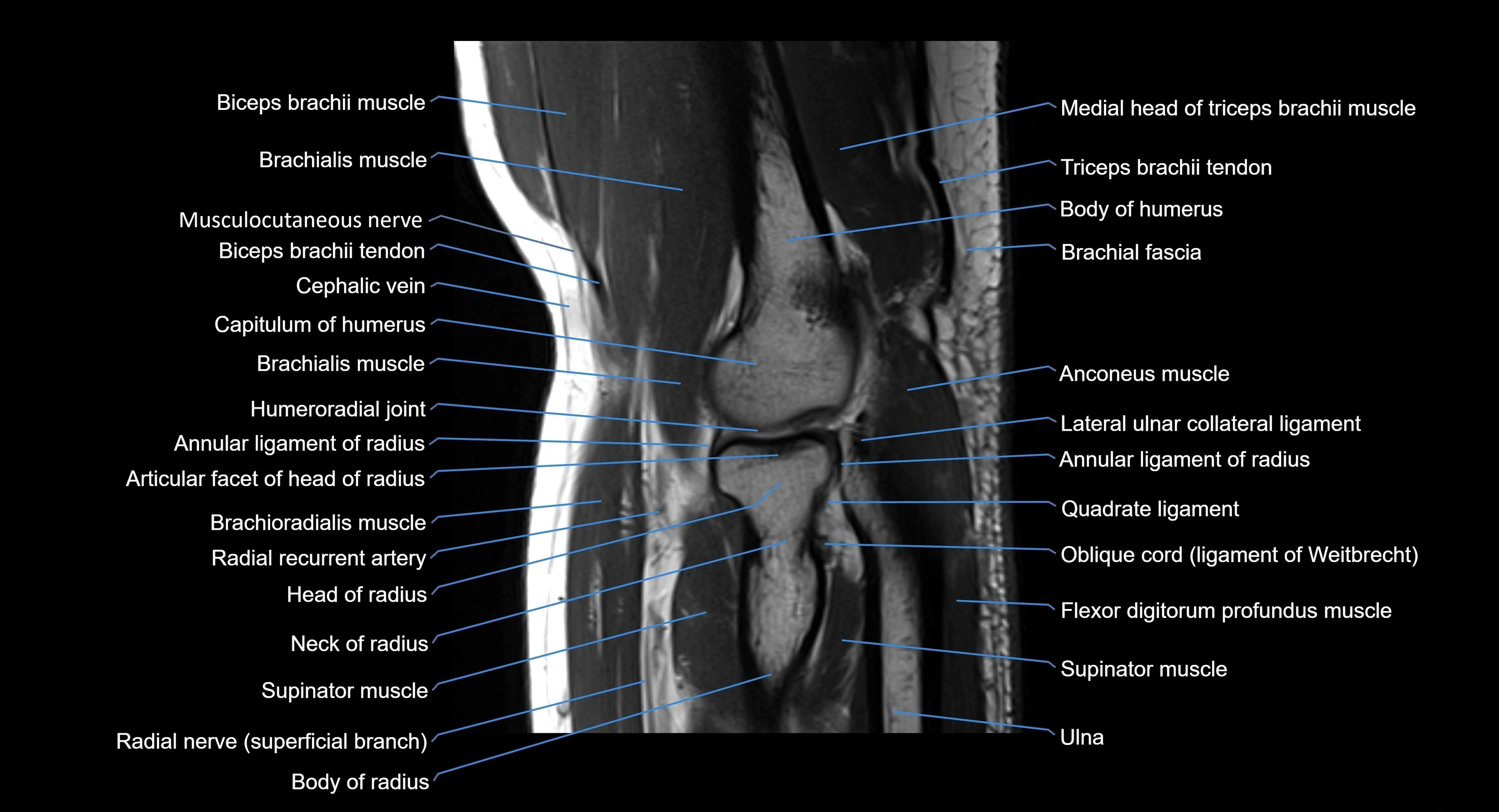 MRI elbow joint  sagittal cross sectional anatomy 3T  radiology  image-img-00001-00016.webp